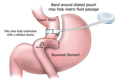 Lap Band over Gastric Bypass